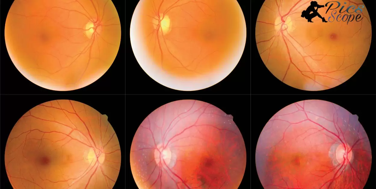 Is Fundus Photography Covered By Insurance?